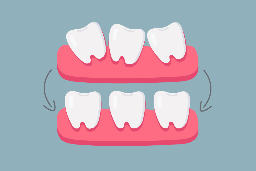 teeth before and after braces